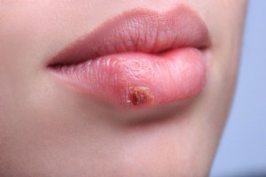 Herpes