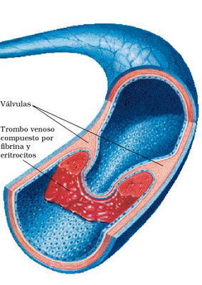 Trombosis: causas y prevención