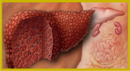 Cirrosis hepática: Diagnóstico y tratamiento