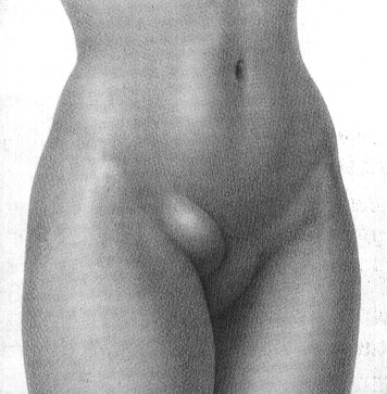 Qué es la hernia inguinal