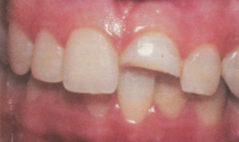 Dientes fracturados: Los traumatismos más comunes y su tratamiento