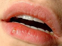 El tratamiento del herpes labial