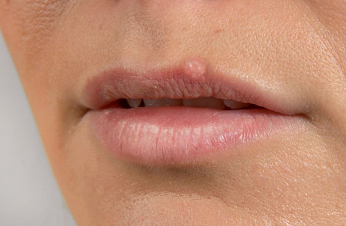¿El asco puede reactivar el herpes labial?