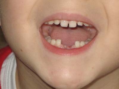 Dientes de leche: Mitos y realidades