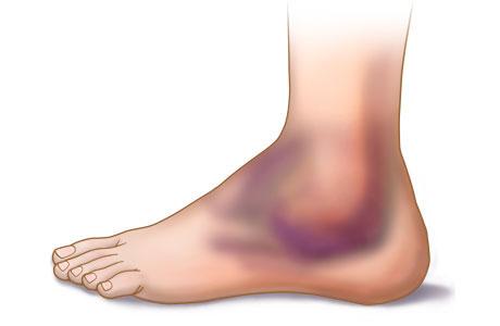 El edema: ¿Qué es?