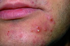 La foliculitis: ¿A qué se debe y cómo combatirla?