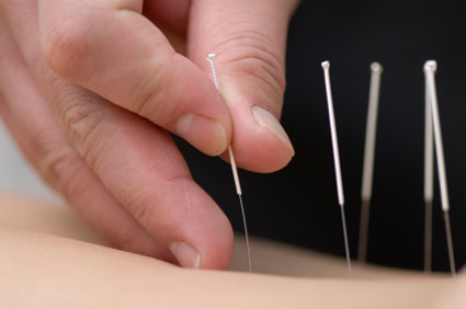 Acupuntura para la depresión