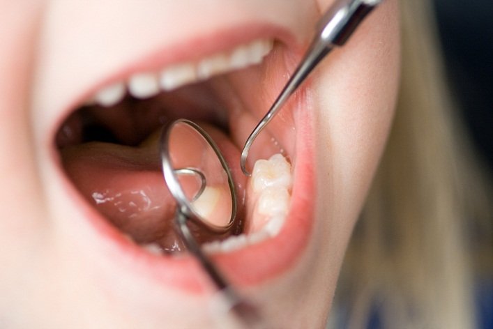 Los riesgos de las cavitaciones dentales
