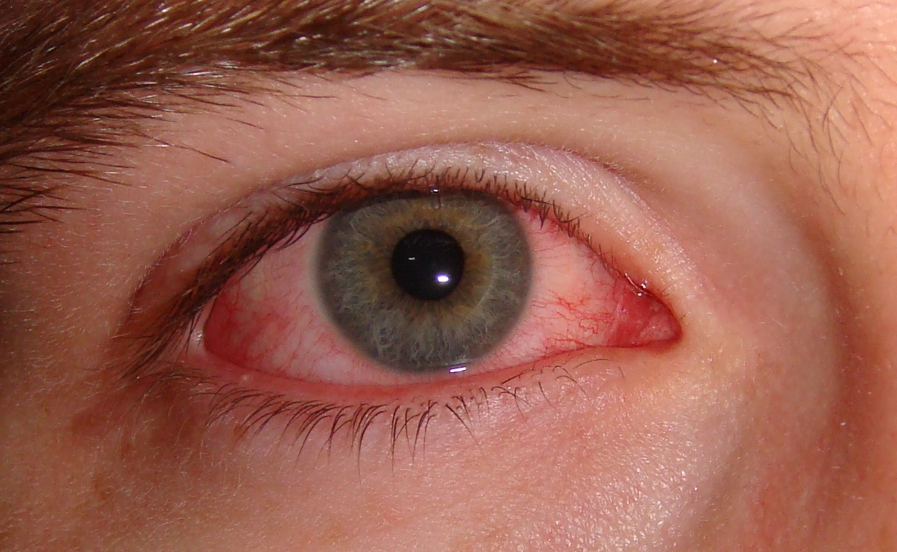 ¿Qué hacer si te salpican productos ácidos en los ojos?