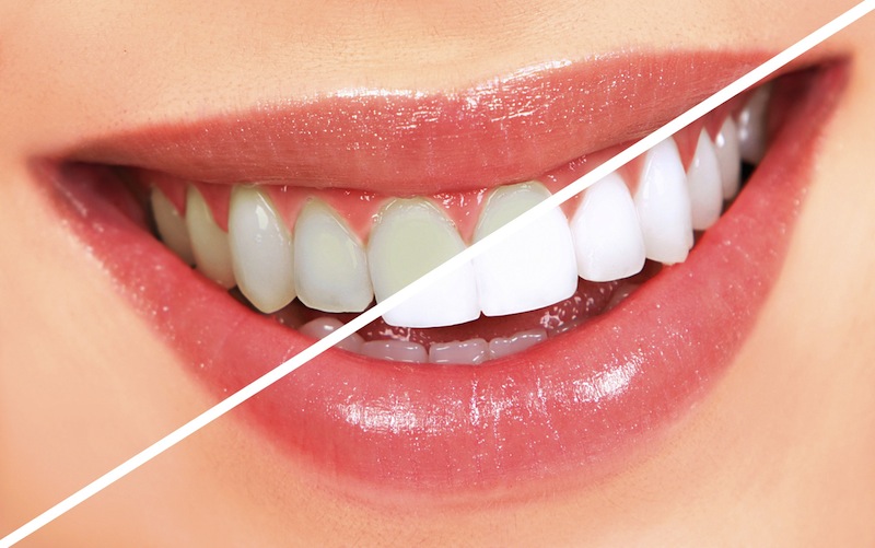 10 alimentos que amarillecen los dientes