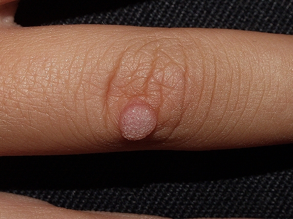 Las verrugas en la piel: ¿Qué indican?