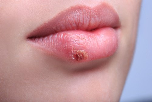 Virus del herpes y Alzheimer: Las relaciones ocultas